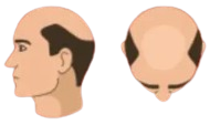 Which stage best describes your current hair loss?